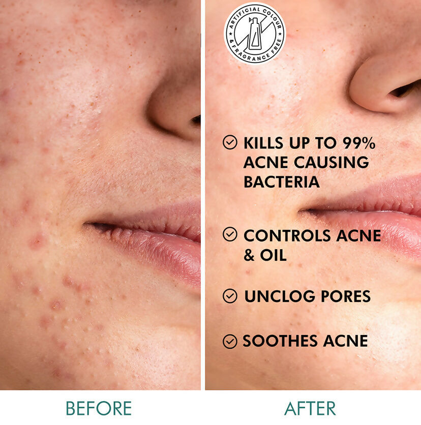 mCaffeine 2% Salicylic Acid Serum Clear Skin Acne Pads - Acne & Oil Control with Matcha Tea