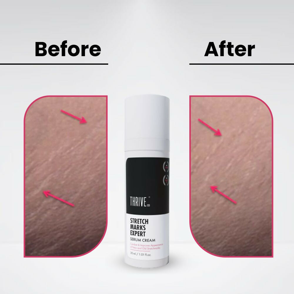 ThriveCo Stretch Marks Expert Serum Cream