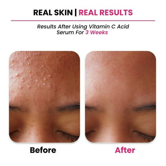 Buy Thriveco 10% Vitamin C+ Hyaluronic Acid Serum from DrMediCart, Ship from India to USA