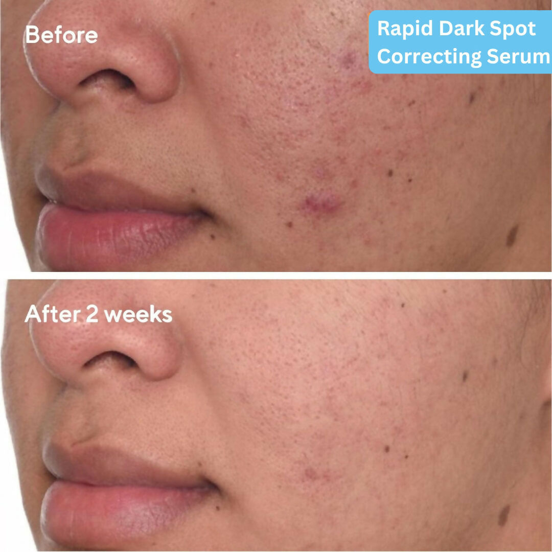 SkinLuv Dark Spot Correcting Serum