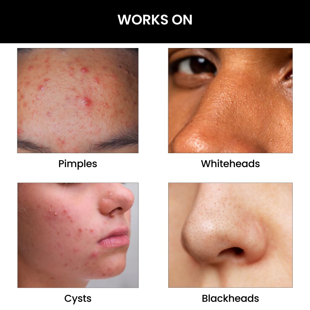 ThriveCo Goodbye Acne Cleanser