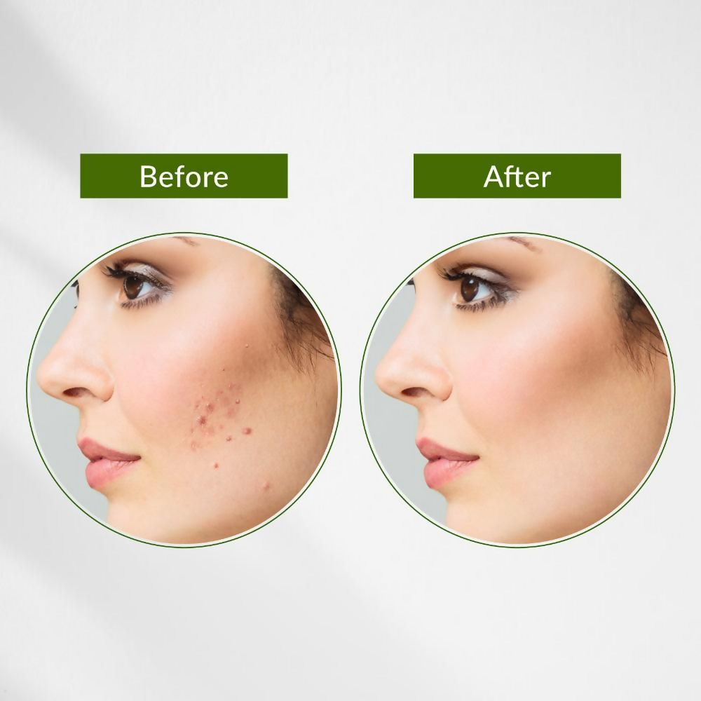 Lotus Botanicals Neem, Tulsi & Salicylic Acid Anti-Acne Purifying Face Gel