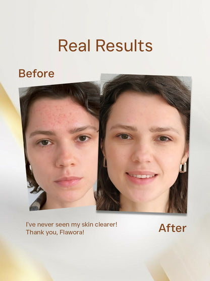 Flawora 24K Gold Face Serum For Brightening, Anti-Aging And Anti Acne Serum To Reduce Blackheads And Open Pores 