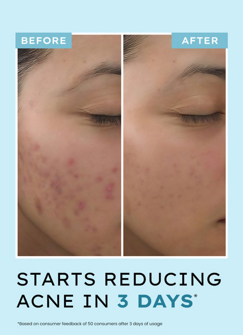 Hyphen By Kriti Sanon Acne Defence Daily Serum With 2% Salicylic Acid Treats Active Acne Prevents Breakouts