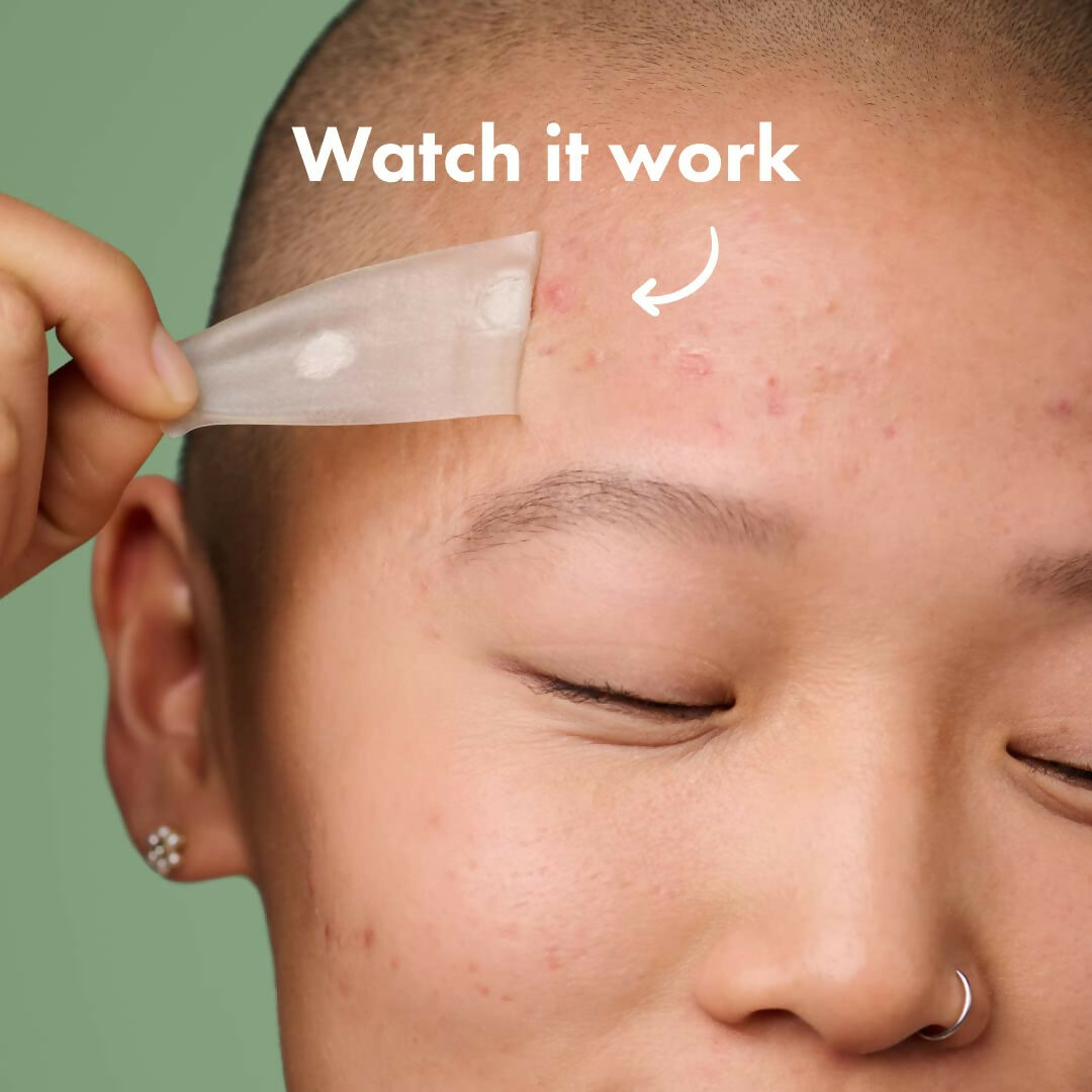Mighty Patch Surface - Hydrocolloid Large Acne Pimple Patches Spot Treatment for Body and Larger Breakouts on Cheek, Forehead, Chin