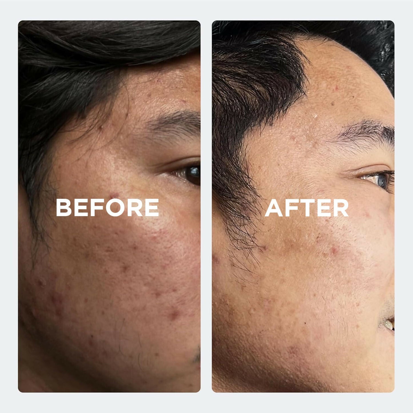SkinLuv Clinify Anti Acne Serum with Salicylic Acid