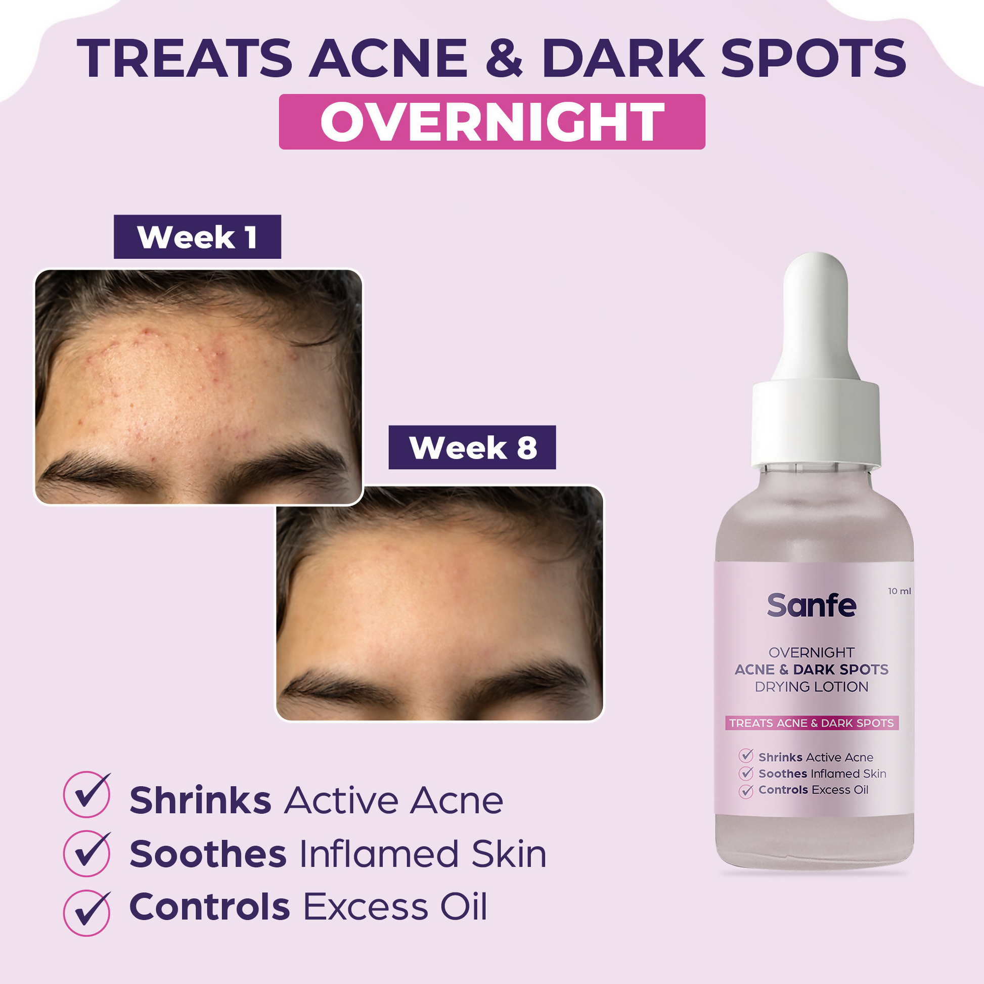Sanfe Overnight Acne & Dark Spots Drying Lotion