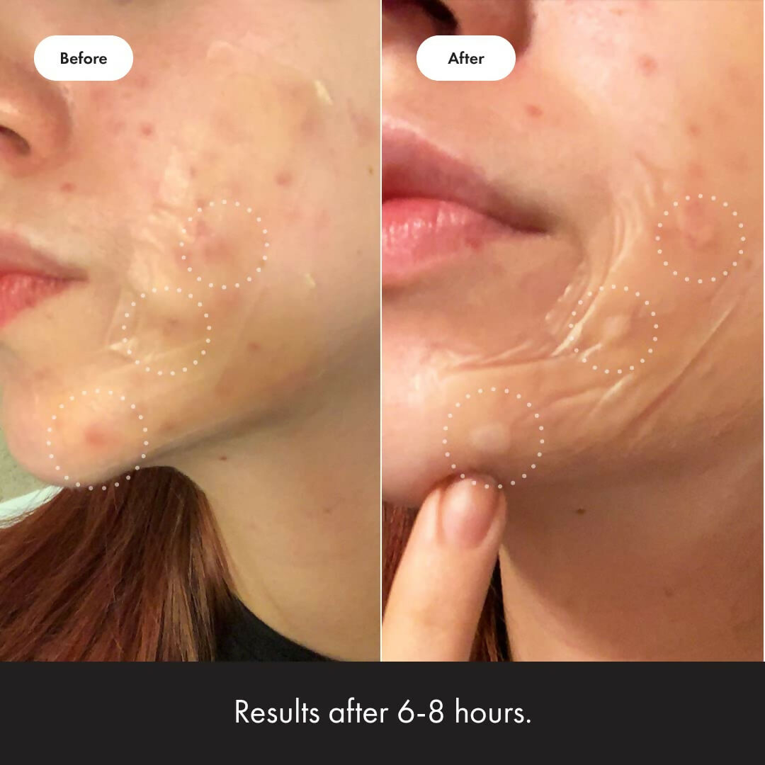 Mighty Patch Surface - Hydrocolloid Large Acne Pimple Patches Spot Treatment for Body and Larger Breakouts on Cheek, Forehead, Chin