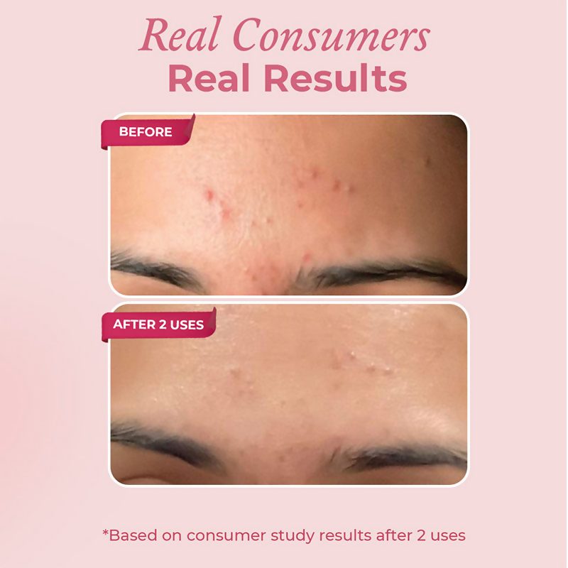 The Pink Foundry Acne Spot Corrector With Salicylic Acid For Active Acne Blackheads & Whiteheads