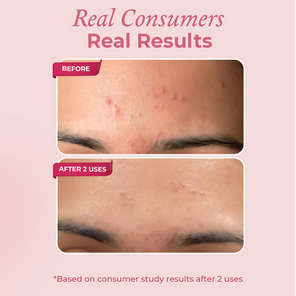 The Pink Foundry Acne Spot Corrector With Salicylic Acid For Active Acne Blackheads & Whiteheads