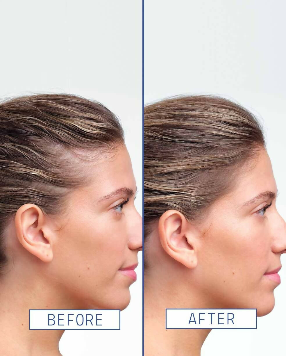 Aavrani Hair Density Boosting Treatment (Serum) - DrMediCart