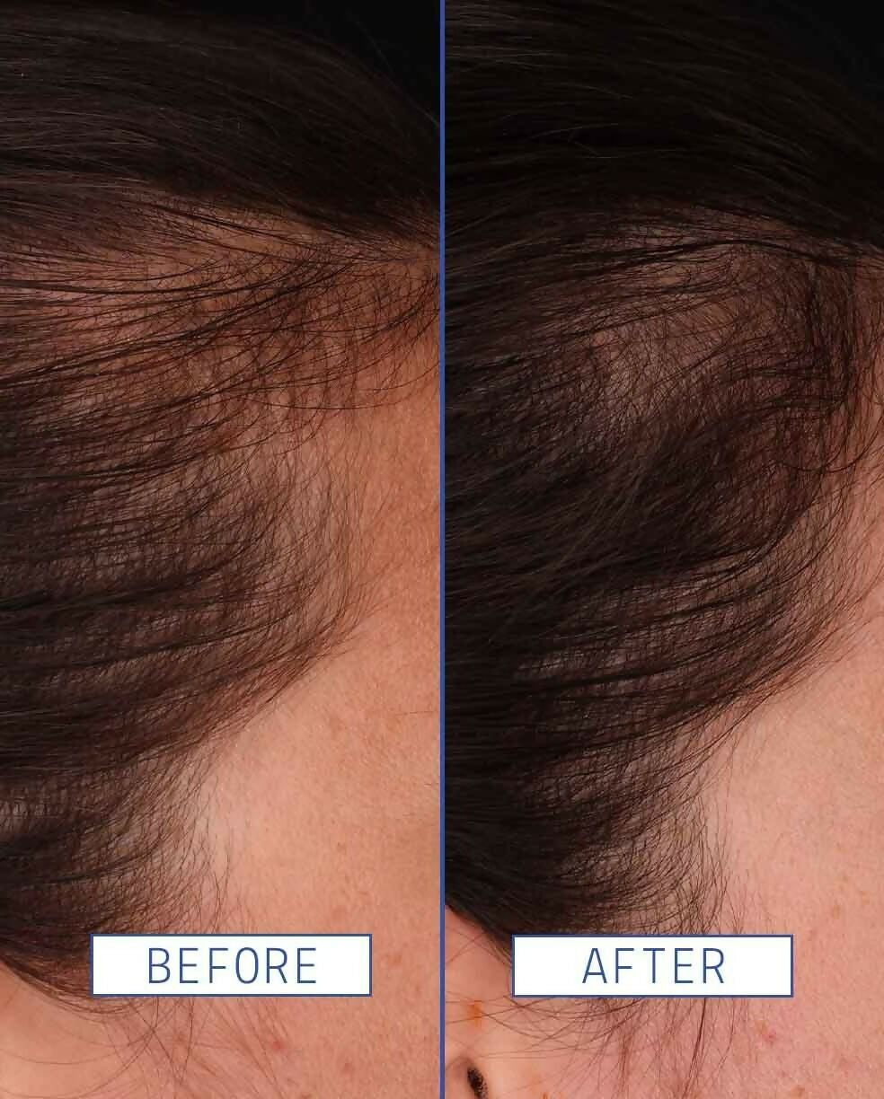 Aavrani Hair Density Boosting Treatment (Serum) - DrMediCart