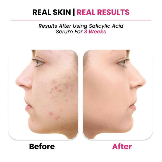 Buy ThriveCo 2% Salicylic acid Serum from DrMediCart, Ship from India to USA