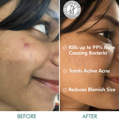 mCaffeine 1% Salicylic Acid 1% Succinic Acid & Matcha Tea Acne Arrest Spot Corrector - Treats Active Acne