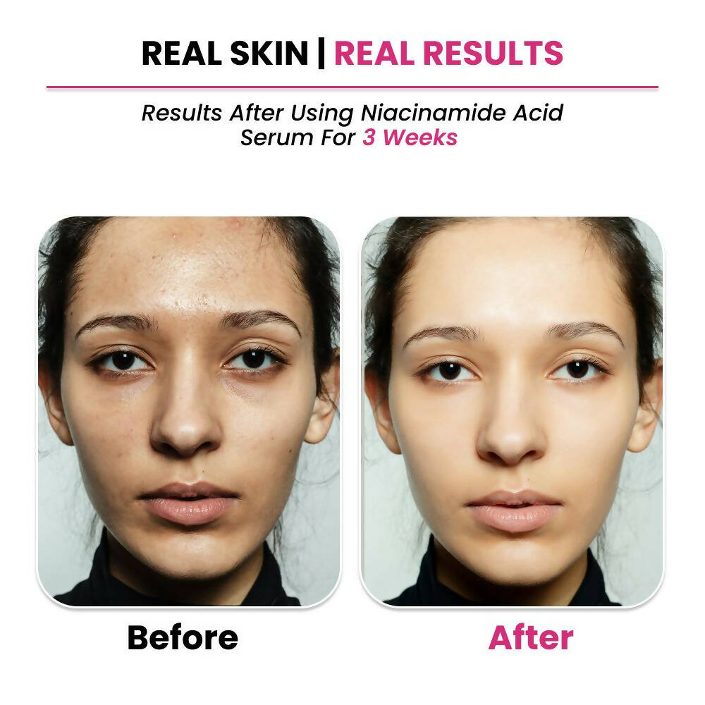 Thriveco 10% Niacinamide + 1% Zinc Pca Serum - Drmedicart